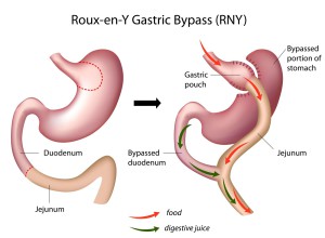 Situatie voor en na een Gastric Bypass operatie