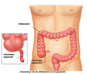 Appendicitis